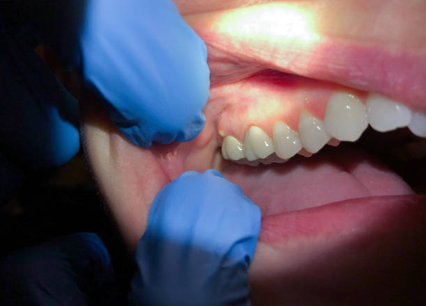 Best Emergency Gum Treatment in Mequon, WI